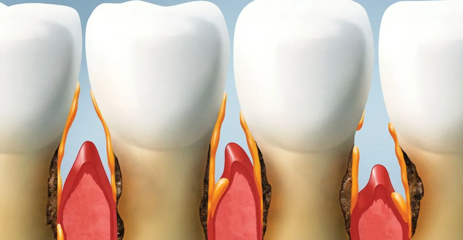 How to Shrink Periodontal Pockets 2